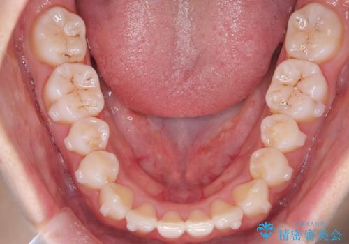 【インビザライン】八重歯が気になるの治療中