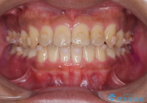 【インビザライン】反対咬合をなおしたいの治療中