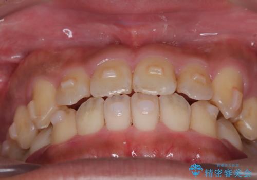 【インビザライン】反対咬合をなおしたいの治療中