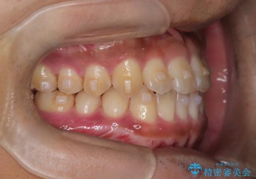 【インビザライン】反対咬合をなおしたいの治療中