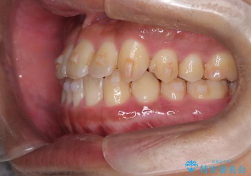 【インビザライン】反対咬合をなおしたいの治療中