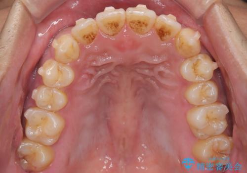 【インビザライン】反対咬合をなおしたいの治療中
