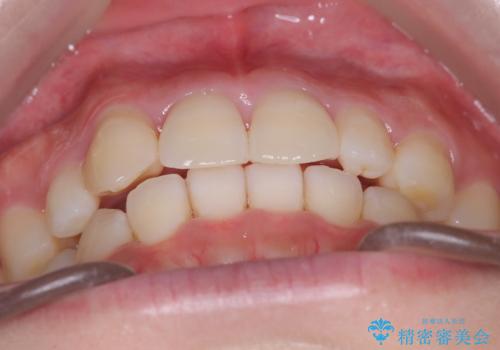 【インビザライン】八重歯が気になるの治療後