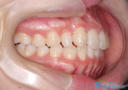 【インビザライン】八重歯が気になるの治療後