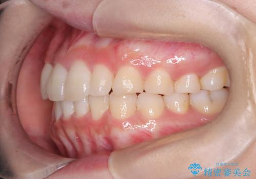 【インビザライン】八重歯が気になるの治療後