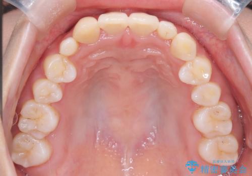 【インビザライン】八重歯が気になるの治療後