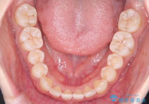 【インビザライン】八重歯が気になるの治療後
