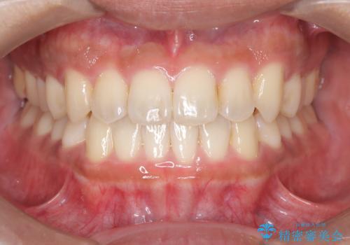 【インビザライン】反対咬合をなおしたいの症例 治療後
