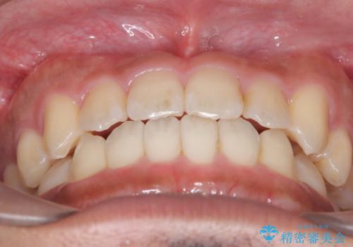 【インビザライン】反対咬合をなおしたいの治療後