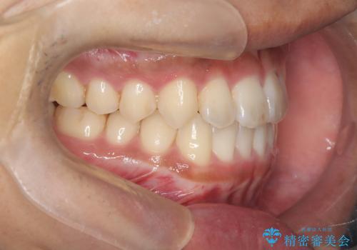 【インビザライン】反対咬合をなおしたいの治療後