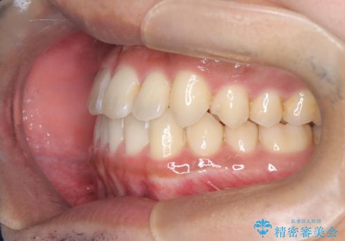 【インビザライン】反対咬合をなおしたいの治療後