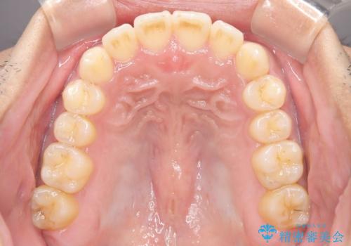 【インビザライン】反対咬合をなおしたいの治療後