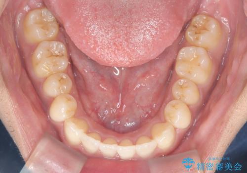 【インビザライン】反対咬合をなおしたいの治療後