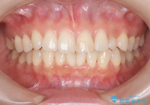 【変色歯】コンポジットレジンからセラミックへの治療前