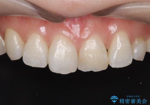 【変色歯】コンポジットレジンからセラミックへの治療前