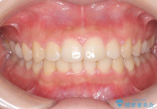 【ワイヤー矯正】前歯のがたがたをなおしたいの治療後