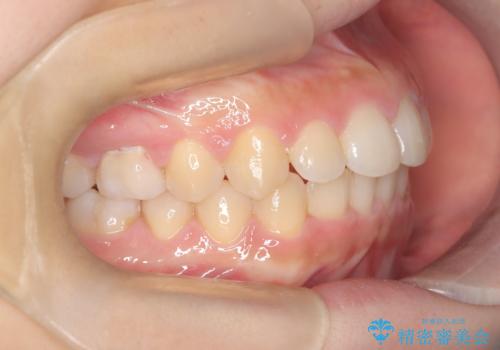 【ワイヤー矯正】前歯のがたがたをなおしたいの治療後