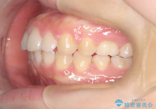 【ワイヤー矯正】前歯のがたがたをなおしたいの治療後