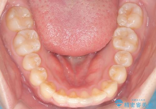 【ワイヤー矯正】前歯のがたがたをなおしたいの治療後
