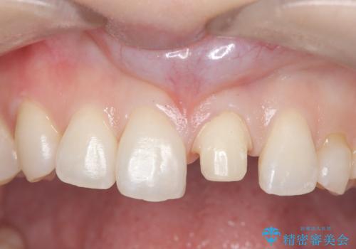 【変色歯】コンポジットレジンからセラミックへの治療中