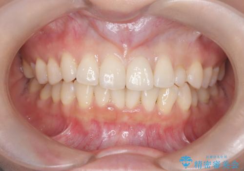 【変色歯】コンポジットレジンからセラミックへの治療後