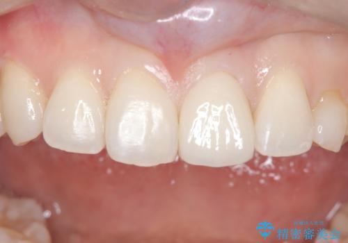 【変色歯】コンポジットレジンからセラミックへの治療後