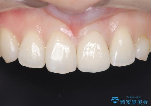 【変色歯】コンポジットレジンからセラミックへの治療後