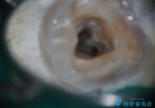 樋状根(といじょうこん)の根管治療の治療前