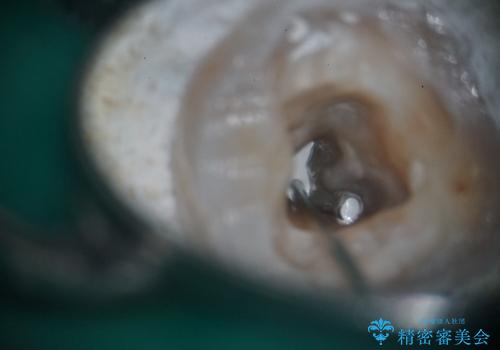 樋状根(といじょうこん)の根管治療の治療中