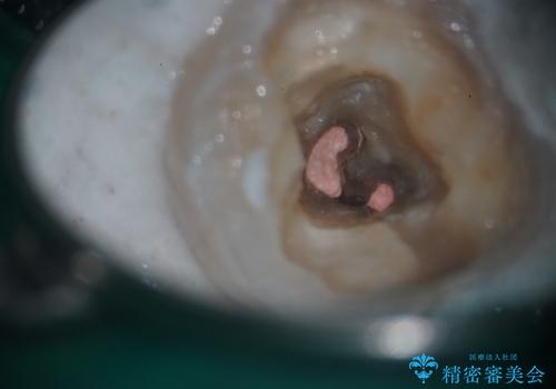 樋状根(といじょうこん)の根管治療の治療後