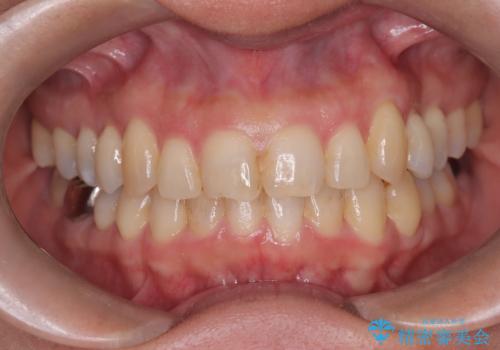 【インビザライン】重度叢生をなおしたいの症例 治療後