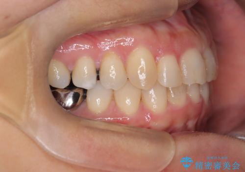 【インビザライン】重度叢生をなおしたいの治療後