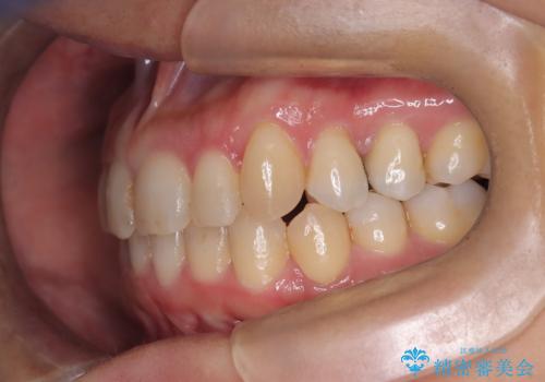 【インビザライン】重度叢生をなおしたいの治療後