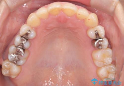 【インビザライン】重度叢生をなおしたいの治療後