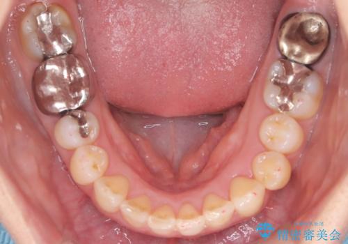 【インビザライン】重度叢生をなおしたいの治療後