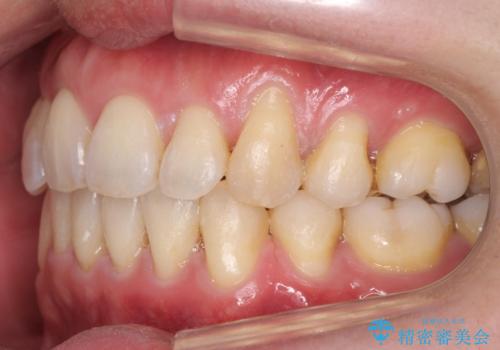 出っ歯をしっかり引っ込めたいの治療後