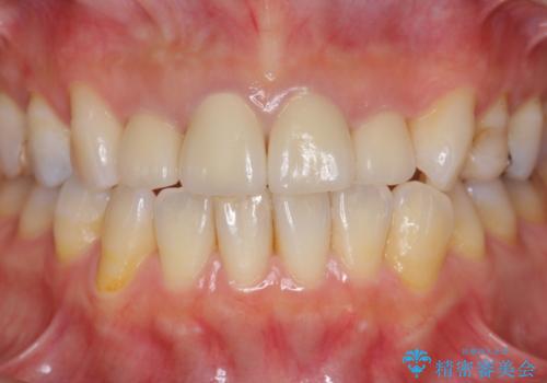 黒ずんだ見栄えの悪い前歯をきれいにしたいの治療後