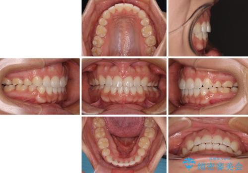気がつくと唇が開く 口元を下げる抜歯矯正の治療後
