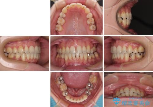 【モニター】上下の八重歯を治したい ワイヤー装置による矯正治療の治療後