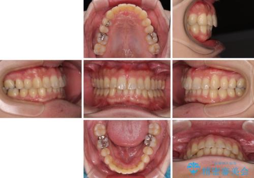 深い咬み合わせで顎が疲れる ワイヤー矯正でディープバイトを解消の治療後