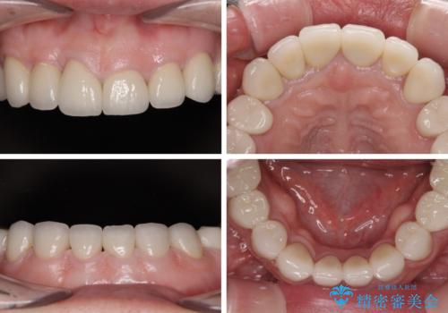 前歯の変色と隙間を治したい 前歯の審美歯科治療の治療後