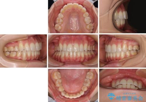 デコボコで磨きにくい歯列　ワイヤー装置での抜歯矯正で歯磨きをしやすくの治療後
