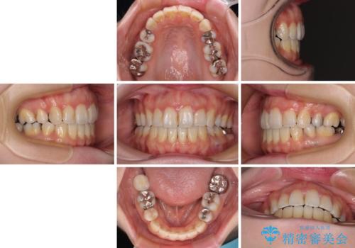 出っ歯と奥歯の欠損　ワイヤー矯正とインプラント治療の治療後