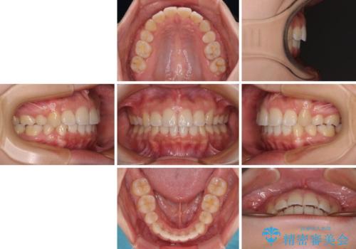 くちばしのような前歯が気になる ワイヤー装置による抜歯矯正治療の治療後
