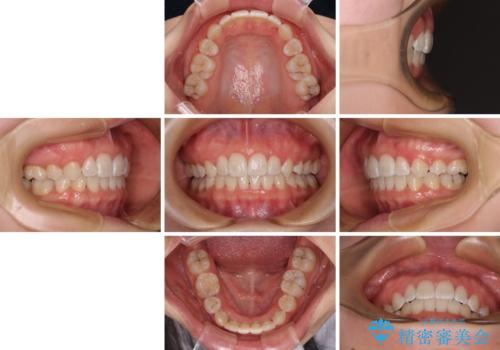 前歯のガタガタを整えたい ワイヤー装置による抜歯矯正治療の治療後