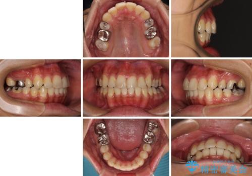 八重歯と開咬 ワイヤー装置での抜歯矯正の治療後