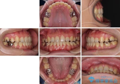 【モニター】舌のトレーニングを行いながら後戻りの再矯正の治療後