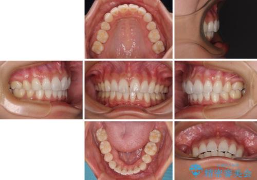 尖った前歯を引っ込めたい 目立たないワイヤー装置での抜歯矯正の治療後
