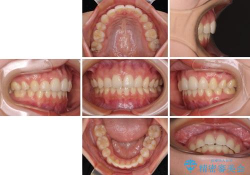 目立たない裏側装置 ハーフリンガルの抜歯矯正の治療後