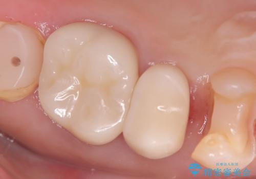 【セラミックインレー】フロスを通すと血が出て臭うの治療中